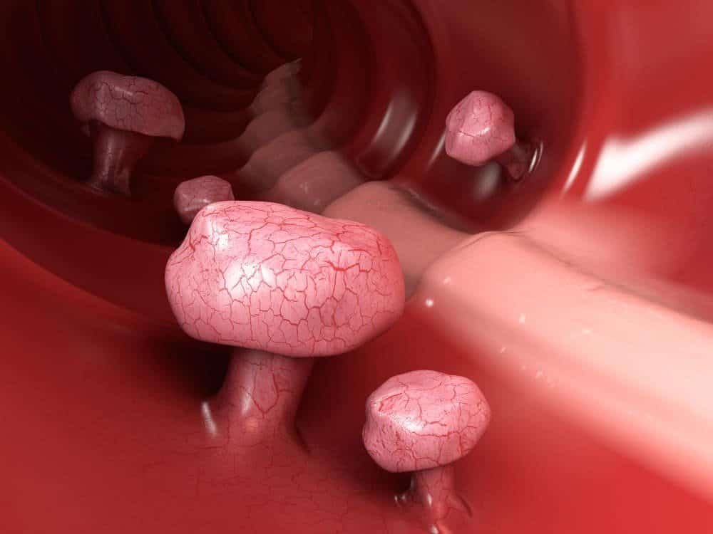 Long-Term Side Effects of Fibroid Embolization: What Women Need to Know