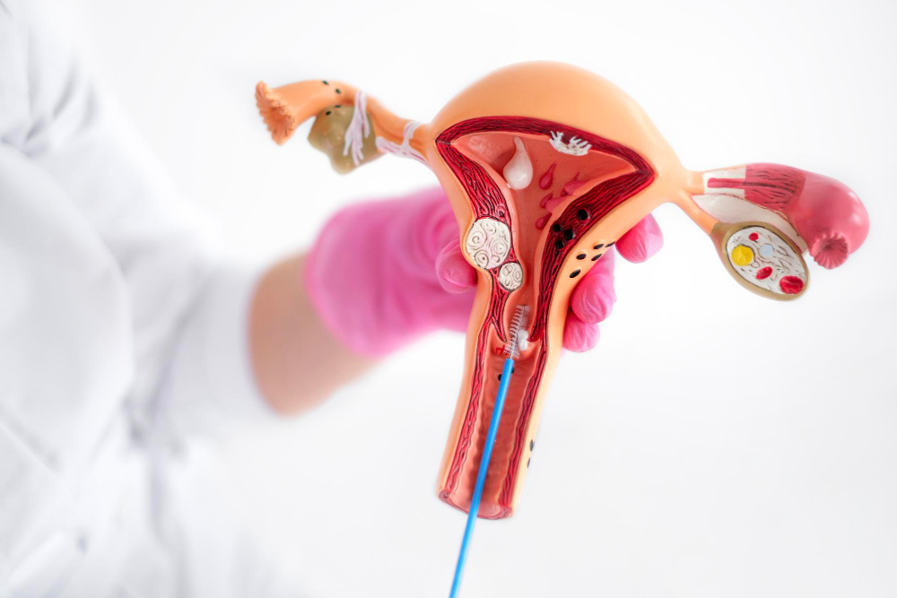 Who Is a Good Candidate for Uterine Fibroid Embolization?