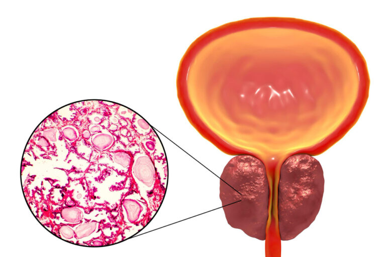 Prostate Artery Embolization Recovery Time: A Faster Path to Relief