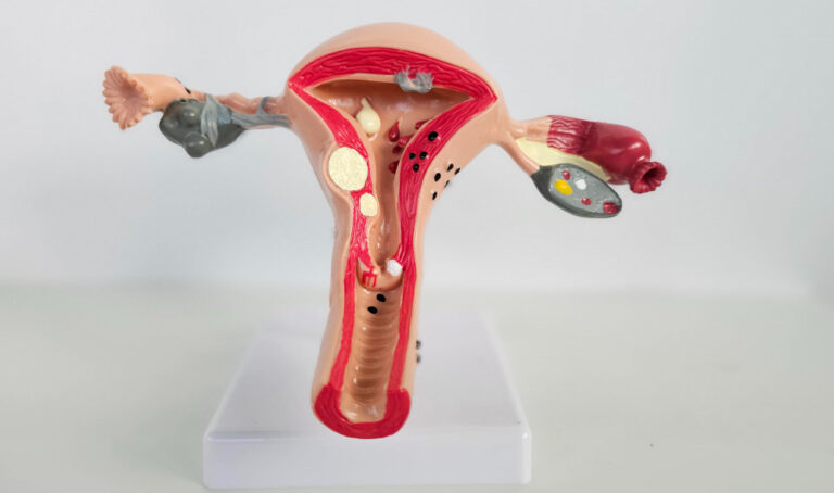 Long-Term Side Effects of Fibroid Embolization: What Women Need to Know