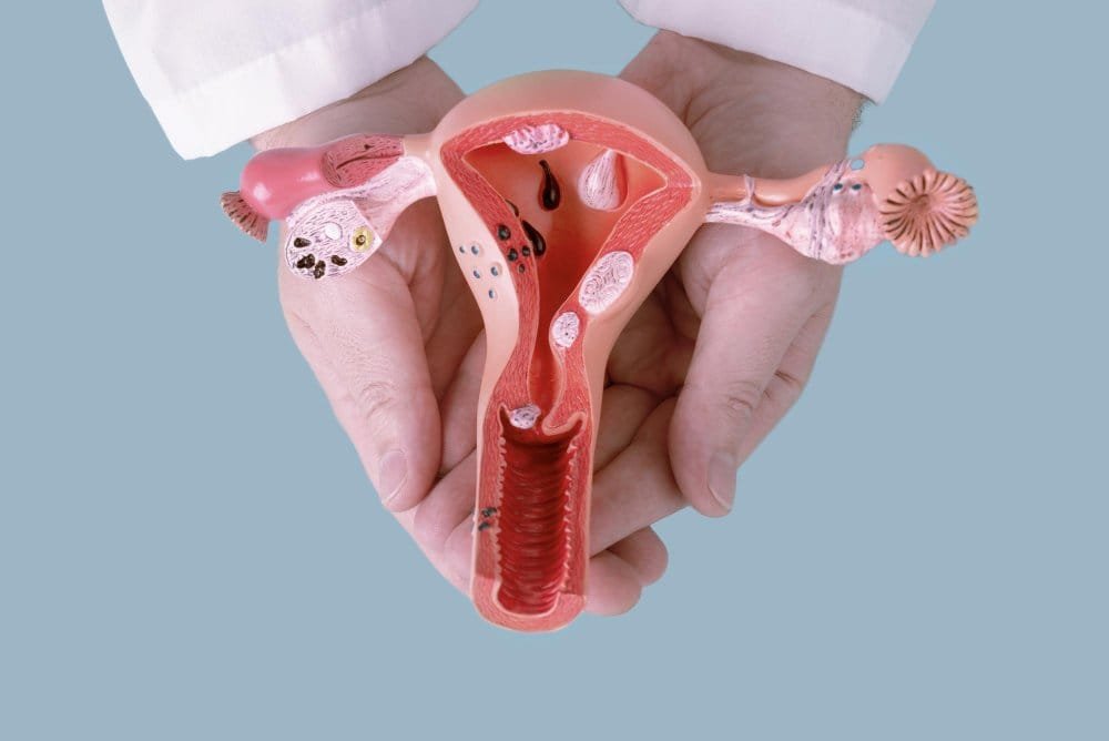 الأشعة التداخلية لعلاج الأورام الليفية