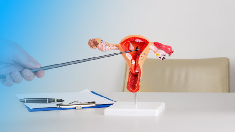 Uterine Artery Embolization for Fibroids