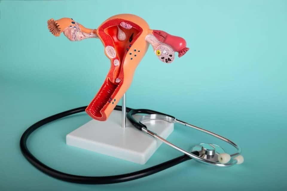 how i cured my adenomyosis without surgery