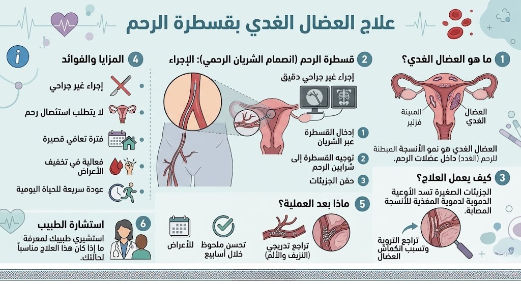 علاج العضال الغدي بقسطرة الرحم