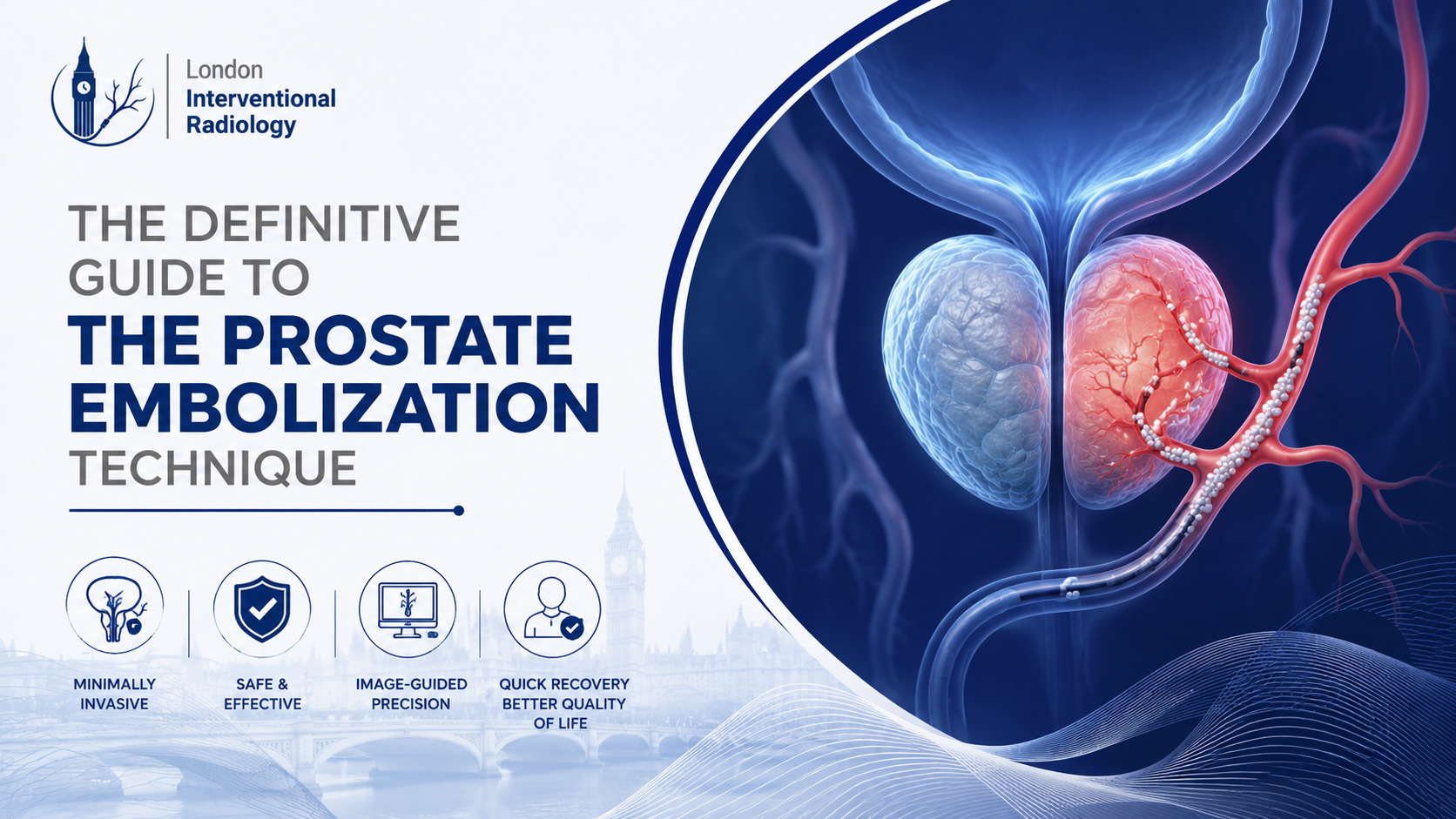 The Definitive Guide to the Prostate Embolization Technique