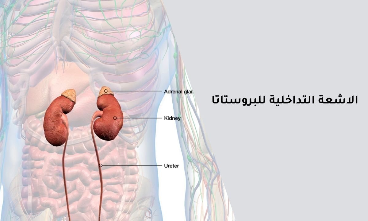 الاشعة التداخلية للبروستاتا